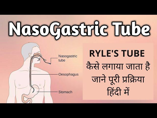Ryle’s Tube | Nasogastric Tube – Nursing Assistant Course