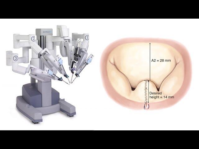 Advantages of Robotic Mitral Valve Repair with Dr. Vinay Badhwar (WVU Heart & Vascular Institute)