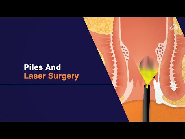 Piles And Laser Surgery | Piles Symptoms and Types | Piles Laser Treatment in Hyderabad