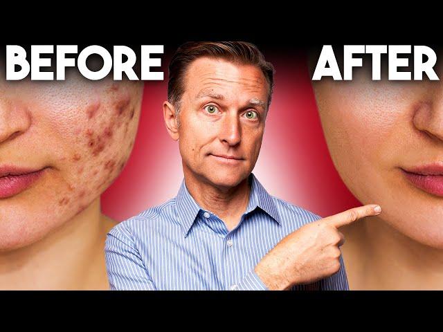 The FASTEST Way to Rid Acne - Dr. Berg