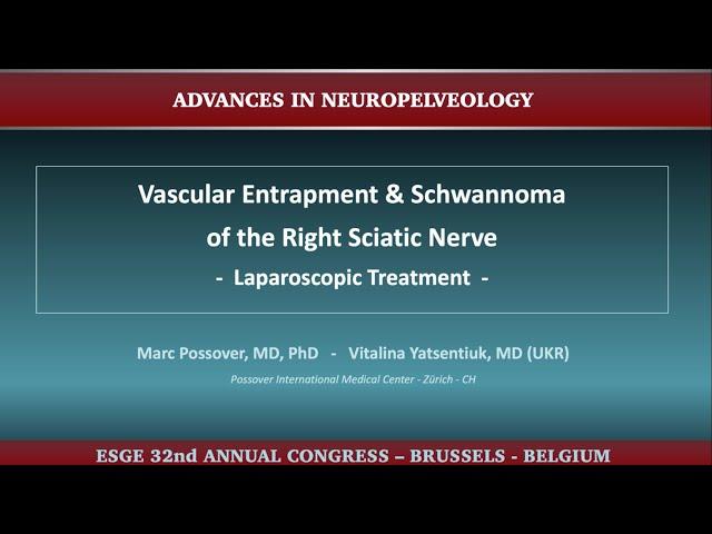 Vascular Entrapment & Schwannoma of the Right Sciatic Nerve