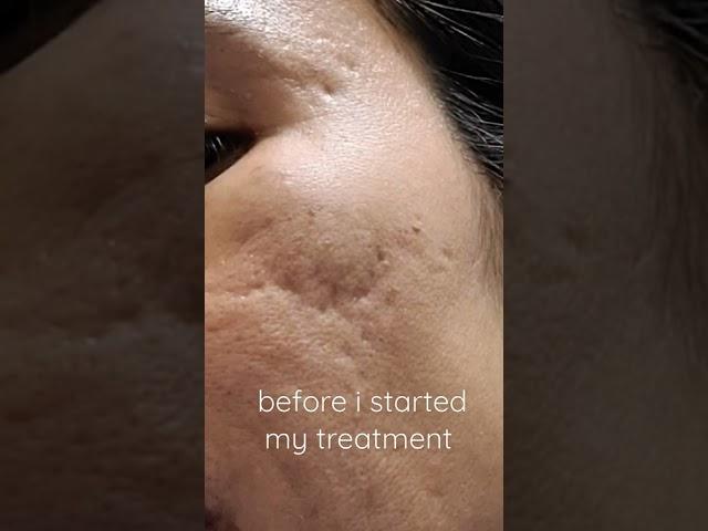 Amazing change | Microneedling | 4th treatment | 4 days after treatment | acne Journey | | HHerman