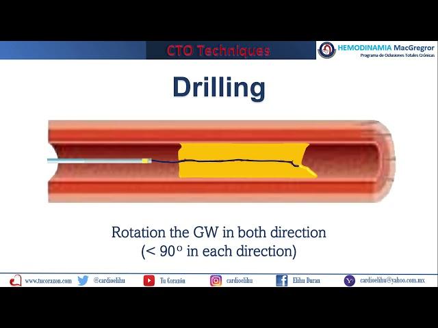 Guide wire displacement techniques