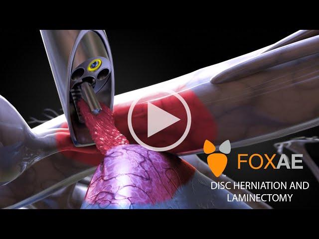 Laminectomy | Legal Animation | Surgery Demonstration