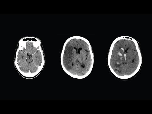 How to Read a CT Scan of the Head - MEDZCOOL