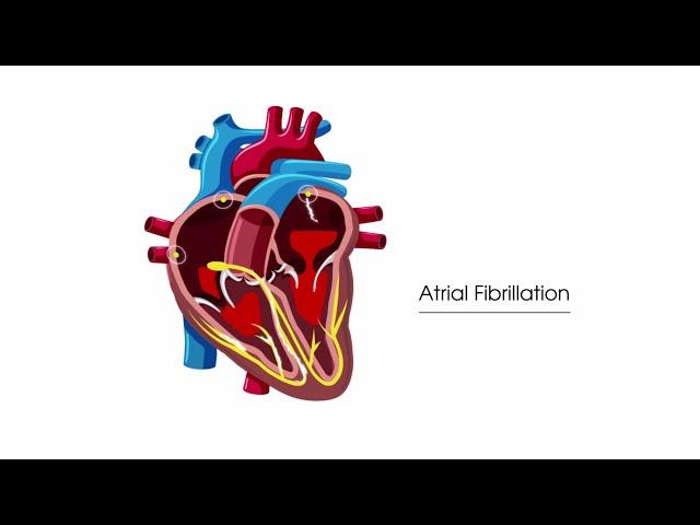 What is atrial fibrillation?