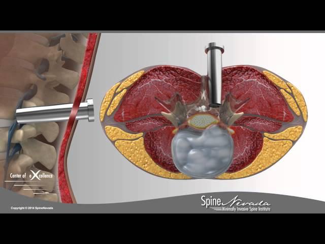 Lumbar Microdiscectomy - Spine Center Northern Nevada, Northern California - Spine Surgery