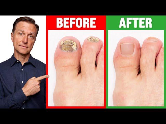 The REAL Cause of Toenail Fungus is ...