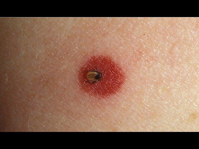 How to Spot Lyme Disease | WebMD