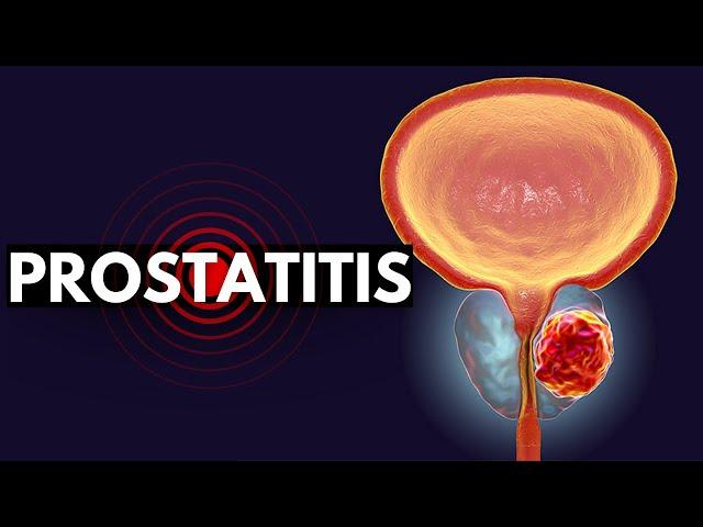 Prostatitis Demystified: From Diagnosis to Relief