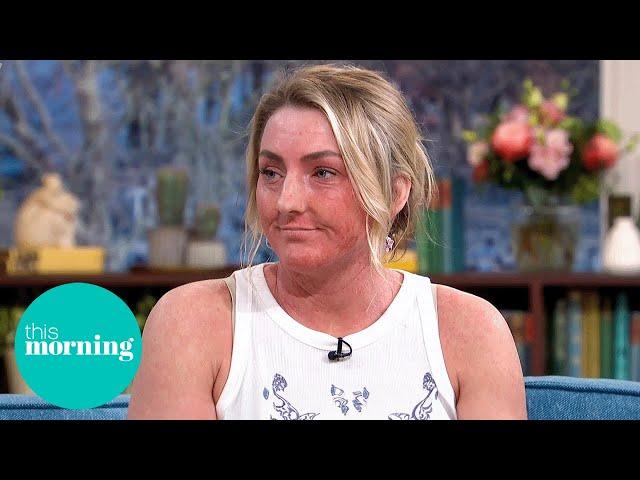 Eczema Warrior Amy Aston on Her Battle and Steroid Withdrawal Awareness | This Morning