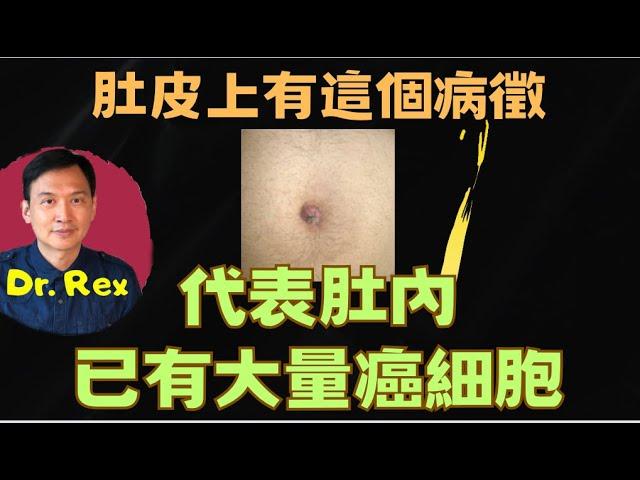 (中英字幕EngSub) 肚皮上出現這個病徵，代表癌症晚期！Watch out for this bump on the belly button it may mean cancer