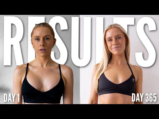 My 1 Year Breast Implant Removal Results *DO I REGRET PLASTIC SURGERY?*