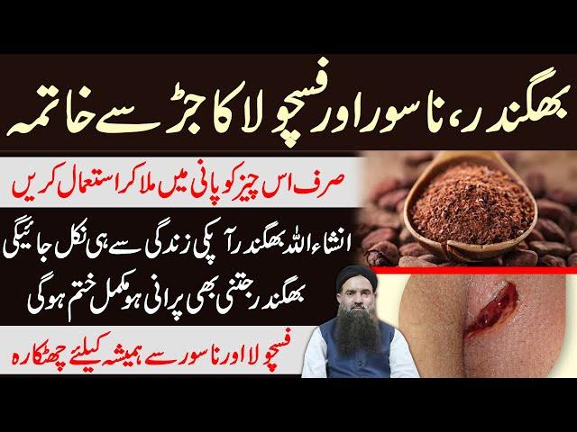 Bhagandar Ka ilaj | Fistula Treatment at Home in Urdu/Hindi | بھگندر کا علاج  Dr Sharafat Ali 2020