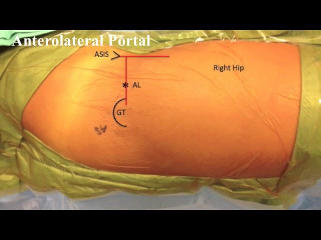 Basic Hip Arthroscopy: Anatomic Establishment of Arthroscopic Portals Without Fluoroscopic Guidance