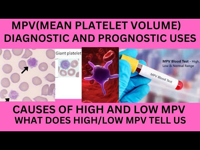 MEAN PLATELET VOLUME(MPV).NORMAL RANGE.CAUSES OF HIGH MPV,LOW MPV,MPV AND THROMBOCYTOPENIA,MPV USES