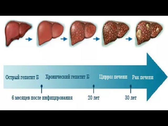 Гепатити В