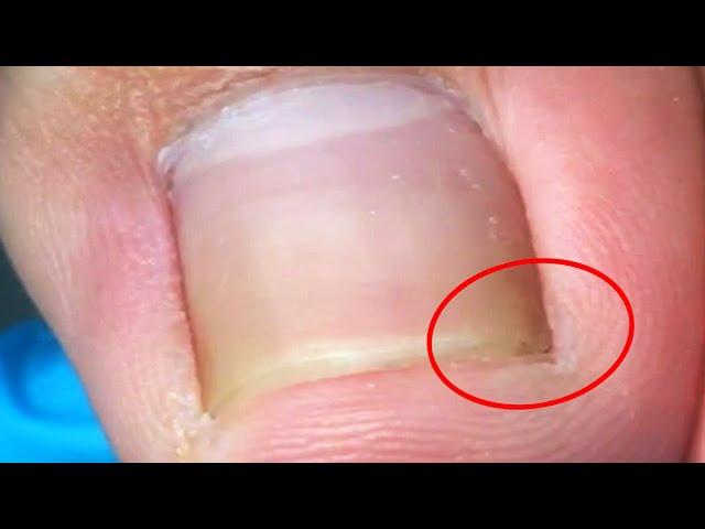 Beautiful toenails, trim ingrown toenails carefully【Crazy pedicure room】