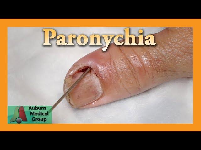 Drained Paronychia | Auburn Medical Group