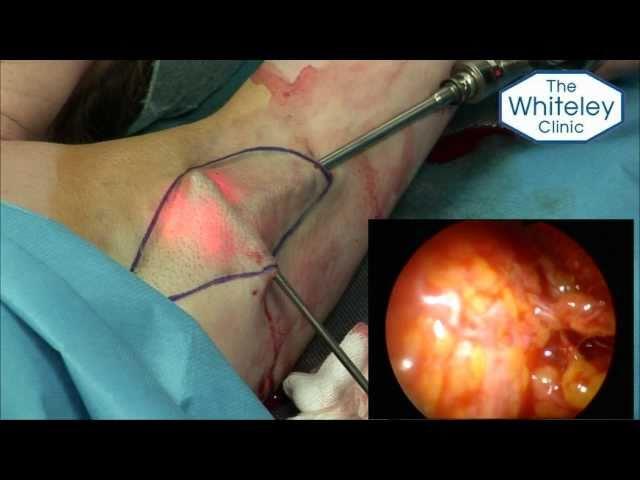 World's First ELSA - Endoscopic Laser Sweat Ablation - cure underarm sweating