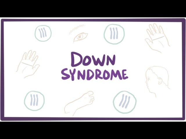 Down syndrome (trisomy 21) - causes, symptoms, diagnosis, & pathology