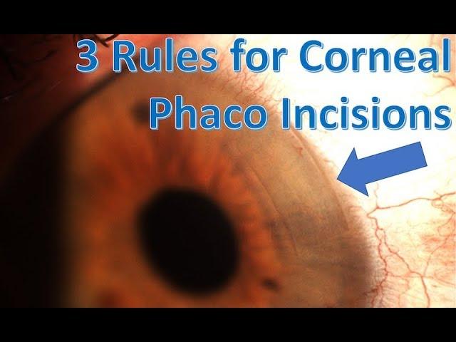 how to make an ideal corneal phaco incision for cataract surgery