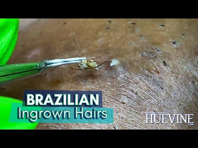 Removing Embedded Hairs From A Brazilian Laser Hair Removal #Showoff​ | HueVine