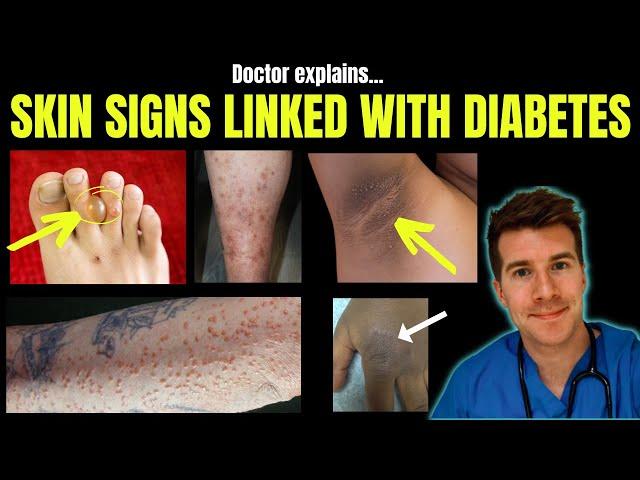 Doctor explains 12 SKIN CONDITIONS associated with DIABETES