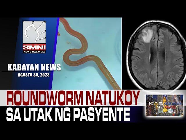 Parasitic worm natagpuan sa utak ng isang babae sa bansang Australia