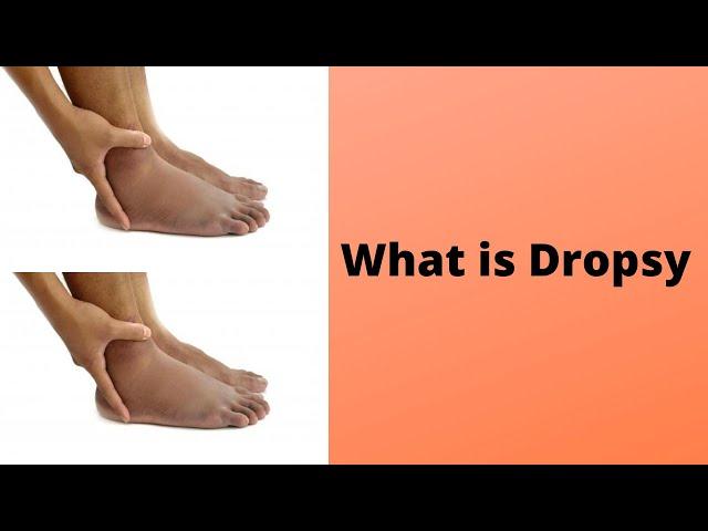 What is Dropsy