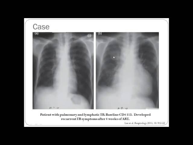 HIV and TB Treatment