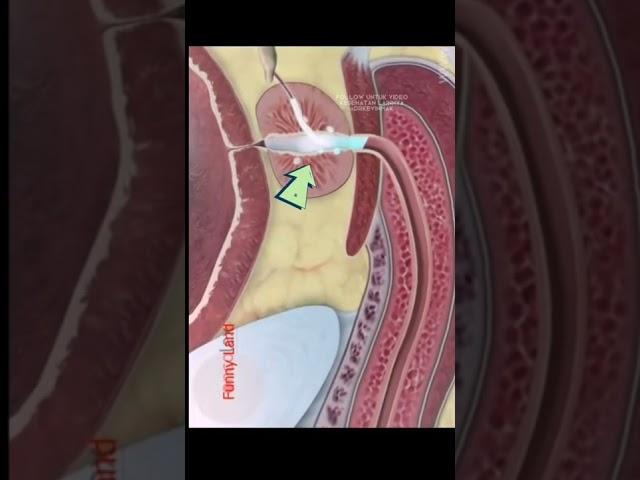 Proses mengeluarkan kecebong pria! #kesehatanpria #tipspromil #viral