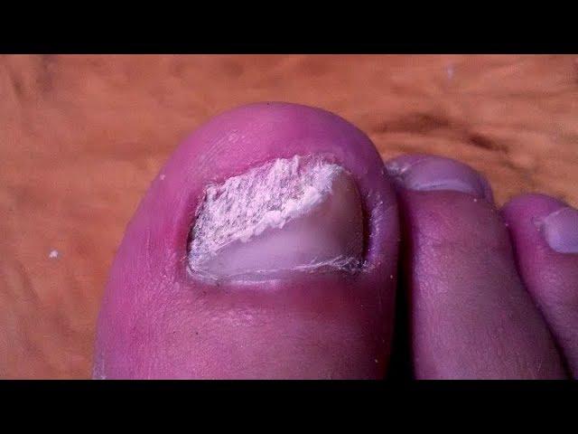 ВЫЛЕЧИЛ грибок Лечение грибка ногтей