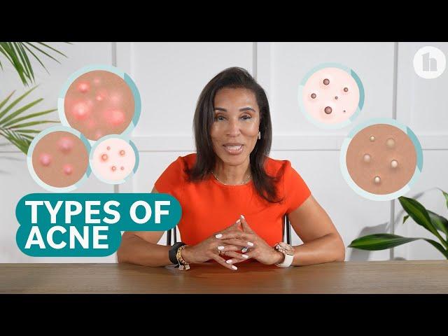 The Different Types of Acne and How to Treat Them