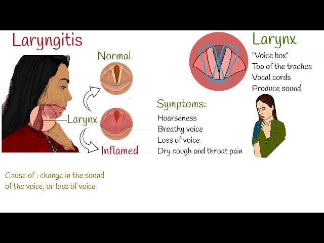 Laryngitis -  Symptoms, causes and treatment