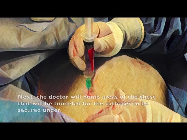 Tunneled Central Venous Catheter Placement