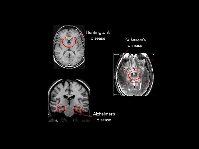 Genetics and Pathogenesis of Amyotrophic Lateral Sclerosis & Frontotemporal Dementia