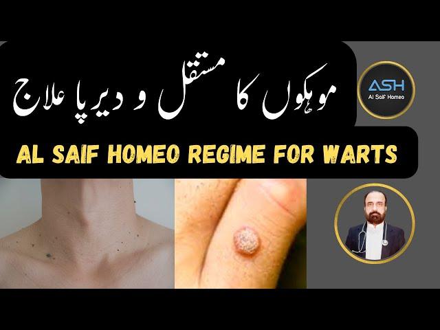 Warts (HPV)! Al Saif homeo Regime for warts |Best Homeopathic Treatment of Warts |Genital Warts Urdu