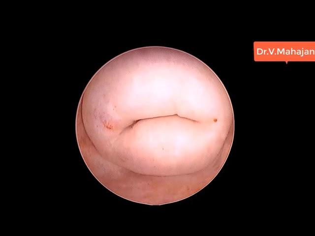 How To Enter Cervical Canal In Vaginoscopy When 30° Hysteroscope is used & FOC at Inferior Position.