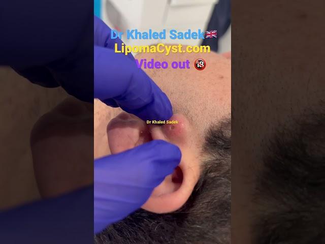 Massive blackhead extraction #skincare #blackheadremoval Dr Khaled Sadek