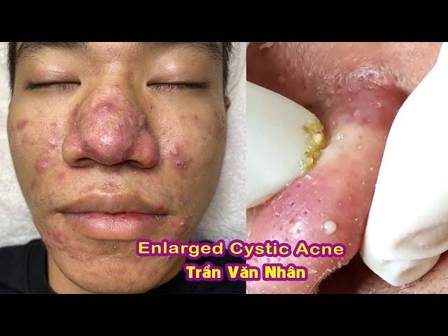 Enlarged Cystic Acne I Điều trị mụn nang khổng lồ Hiền Vân Spa I Trần Văn NhânI 505