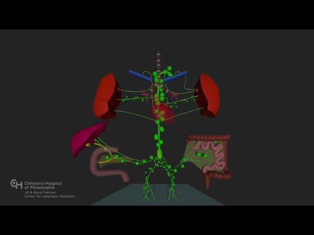 Understanding Plastic Bronchitis