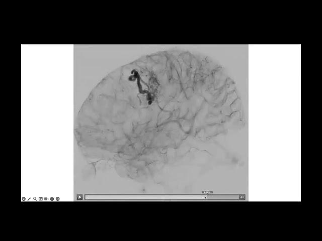 Chair's Corner featuring Christopher Kellner, MD on "Surgical Techniques for AVM Treatment" 08.02.23