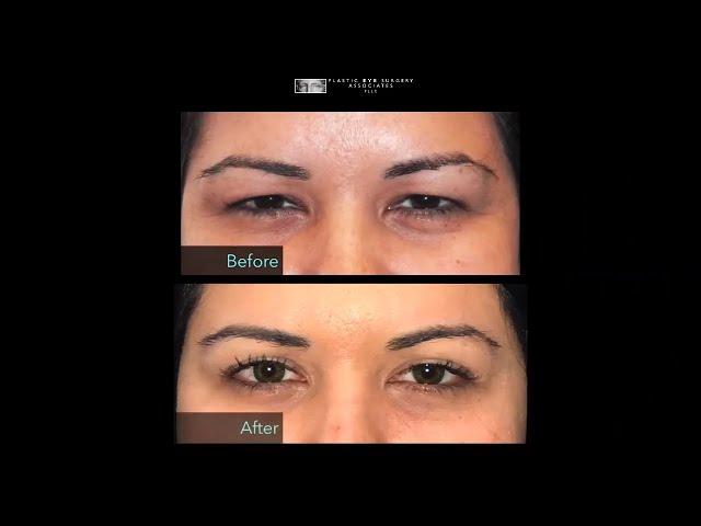 Best Eyelid Surgery in Houston - Dr. Charles Soparkar