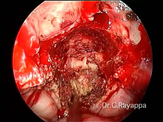 Endoscopic transnasal odontoidectomy by Dr. C. Rayappa