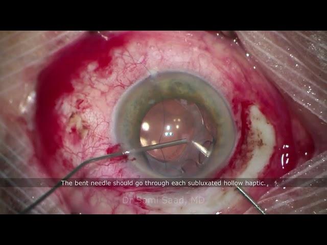 Scleral-sutured IOL with Prolene Suture | Dr Sami A. Saad feat Dr A. Oulmidi