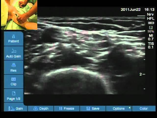Locating median ulnar and musculocutaneous nerve for axillary block