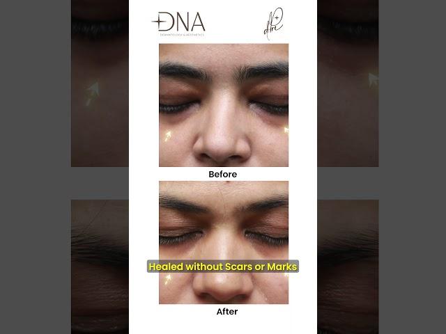 Xanthelasma laser Before and After | By Dermatologist ‍| Dr. Priyanka Reddy | DNA Skin Clinic |