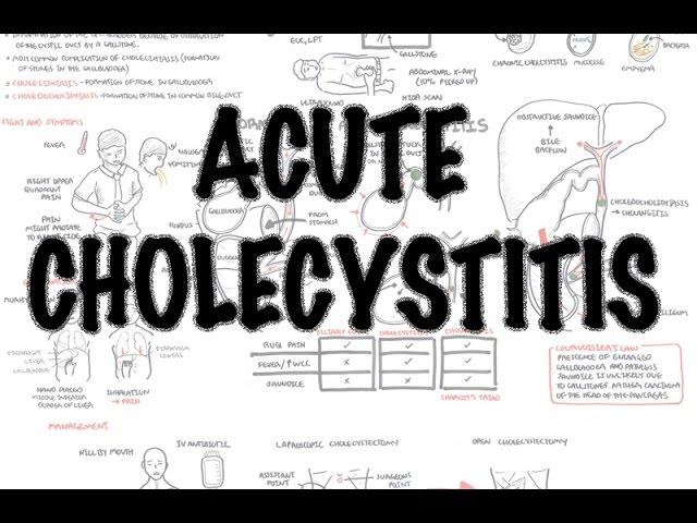 Acute Cholecystitis - Overview (signs and symptoms, pathophysiology, treatment)