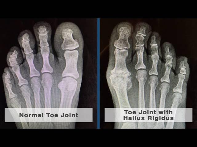 Causes and Treatment of Pain in the Big Toe Joint